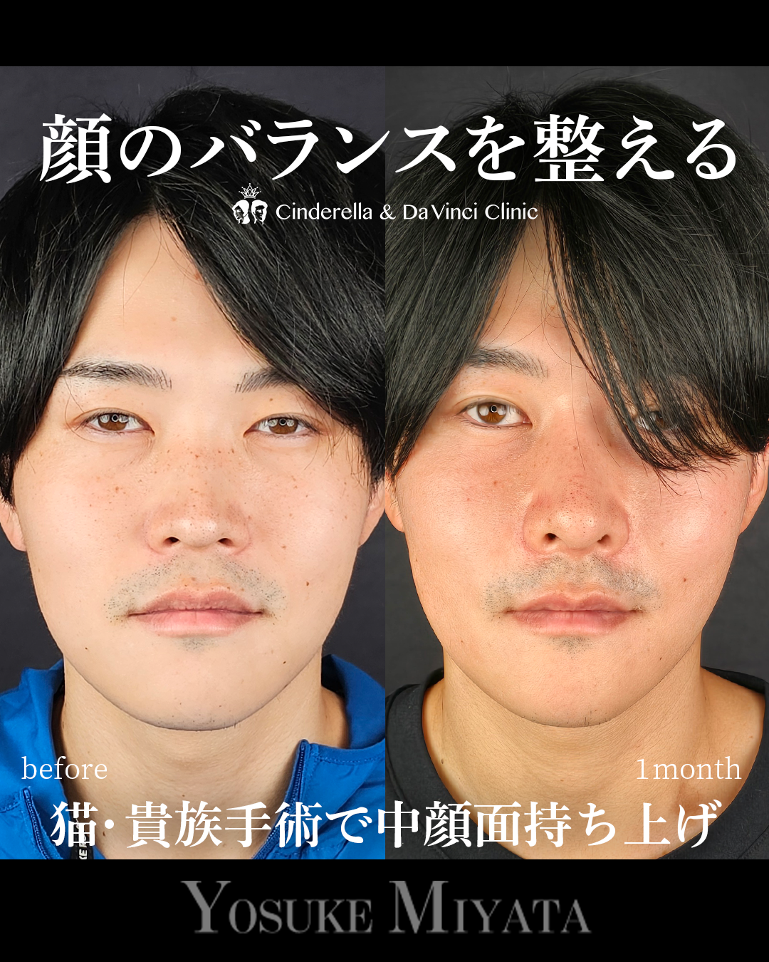 鼻整形で顔のバランスを整えるの画像