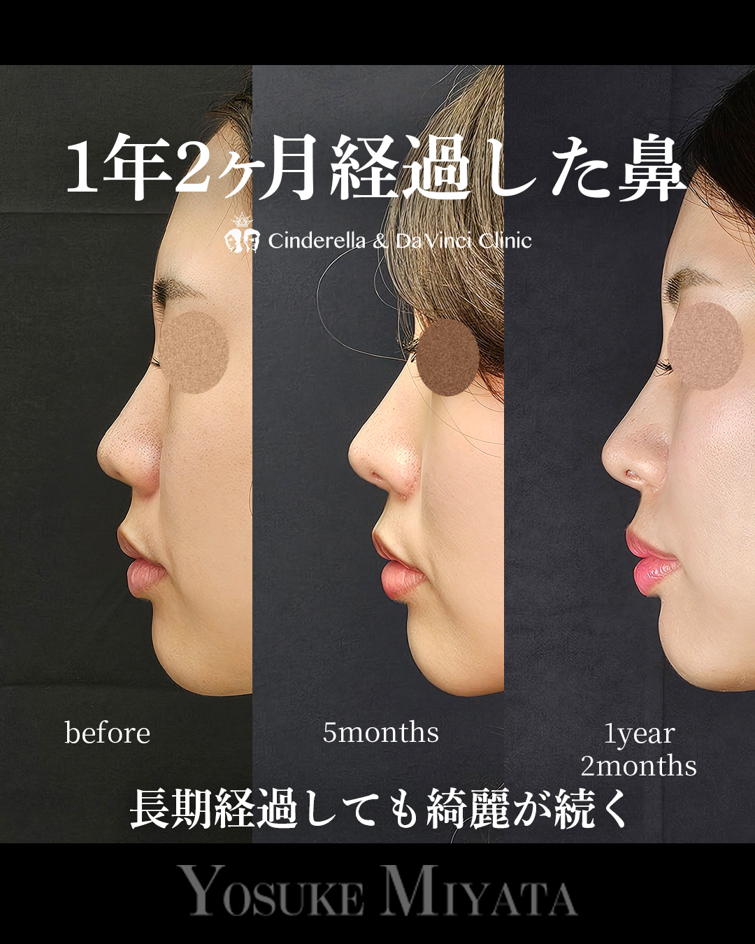 1年2ヶ月経過の鼻の画像