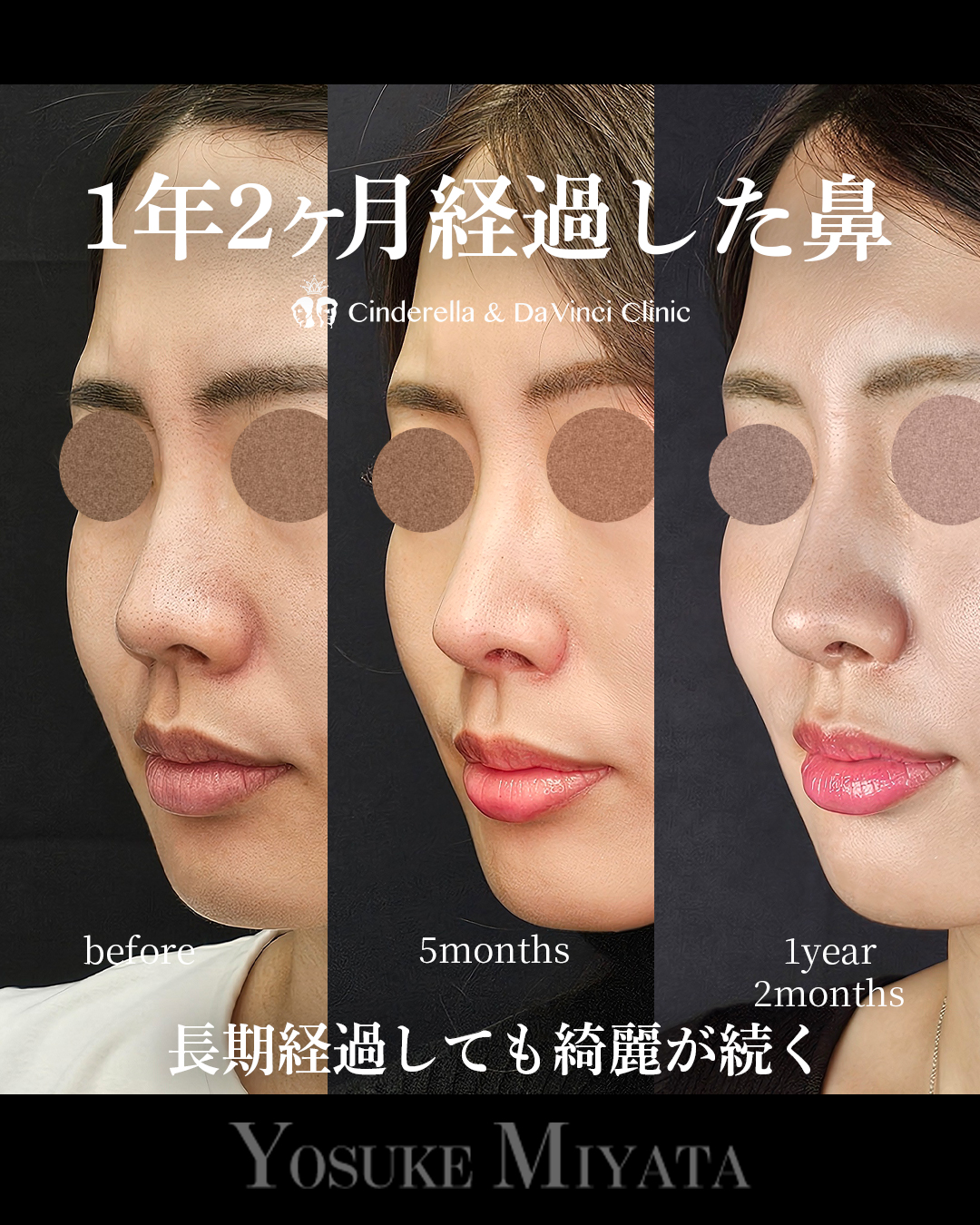 1年2ヶ月経過の鼻の画像