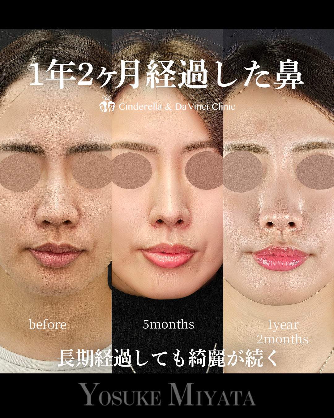 1年2ヶ月経過の鼻の画像