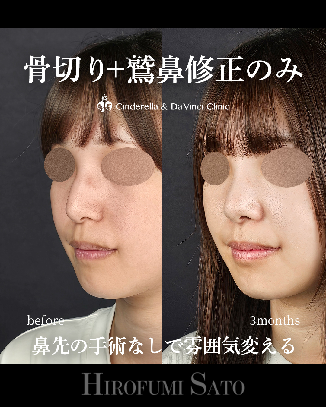 鷲鼻修正と骨切り幅寄せのみの画像