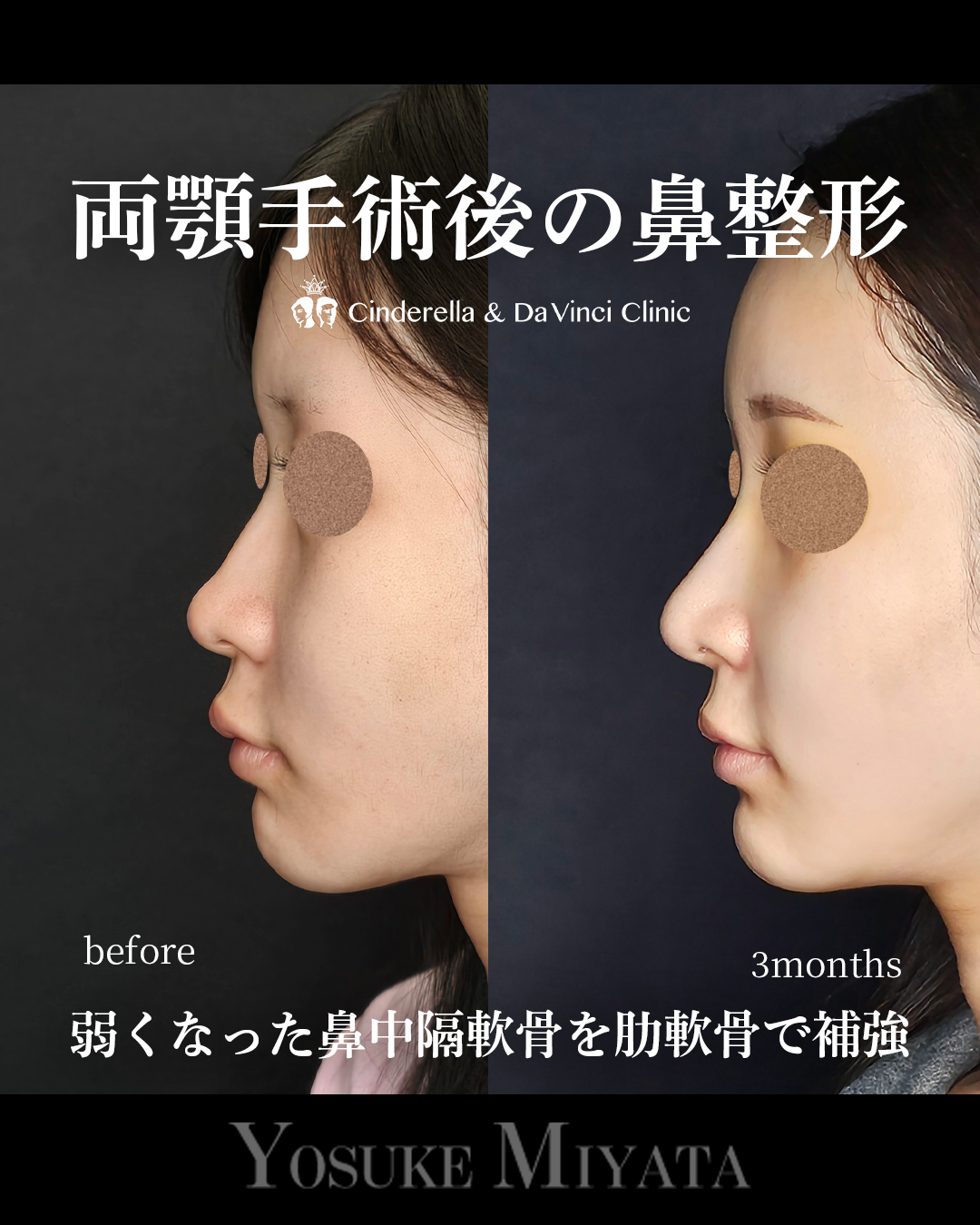 両顎後の鼻整形の画像