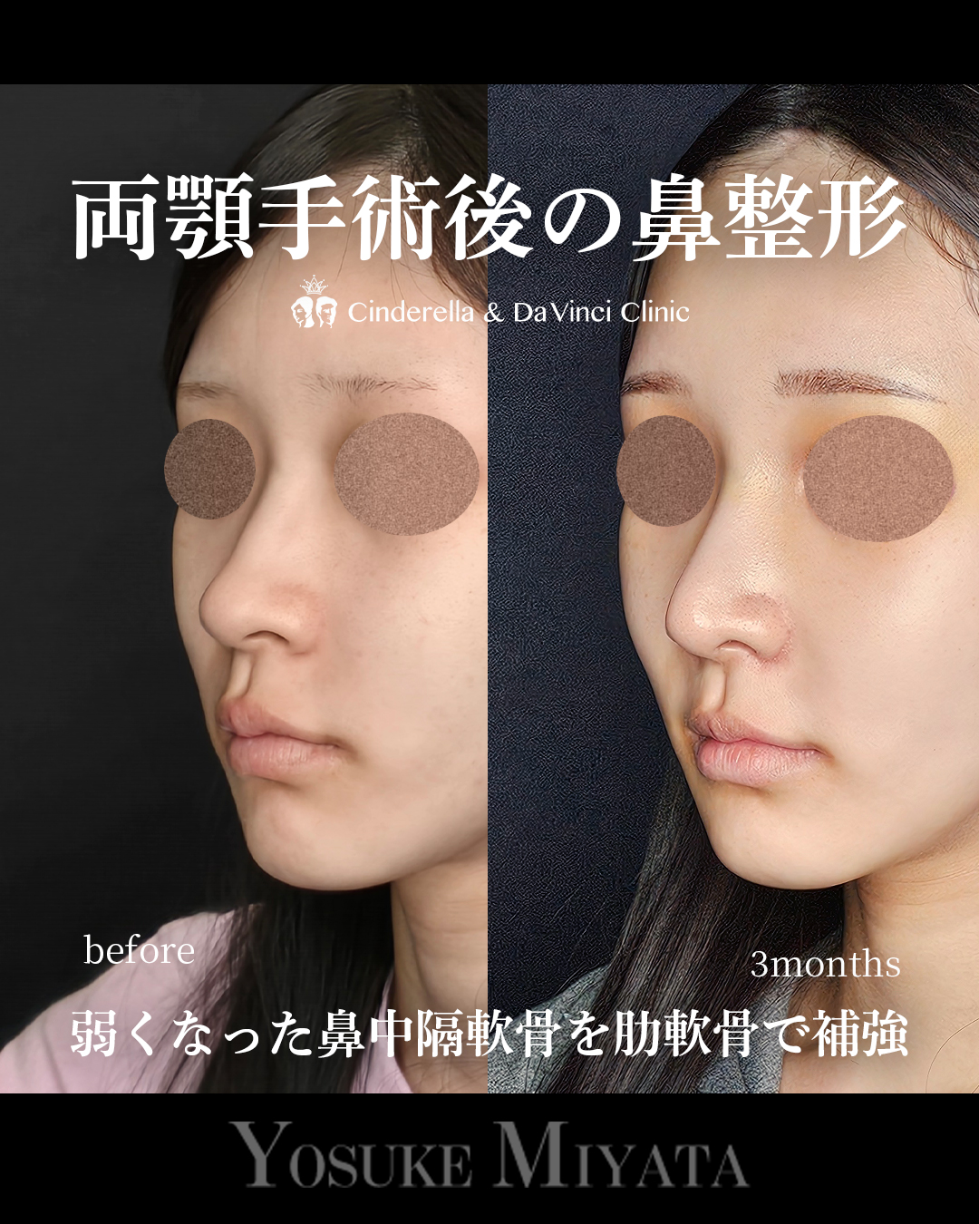両顎後の鼻整形の画像