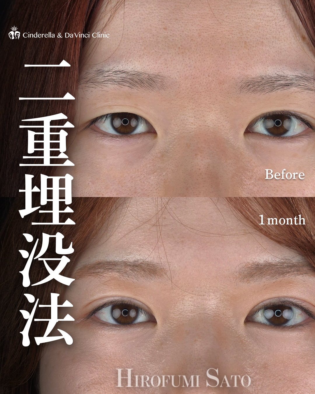 ミックス型二重の画像