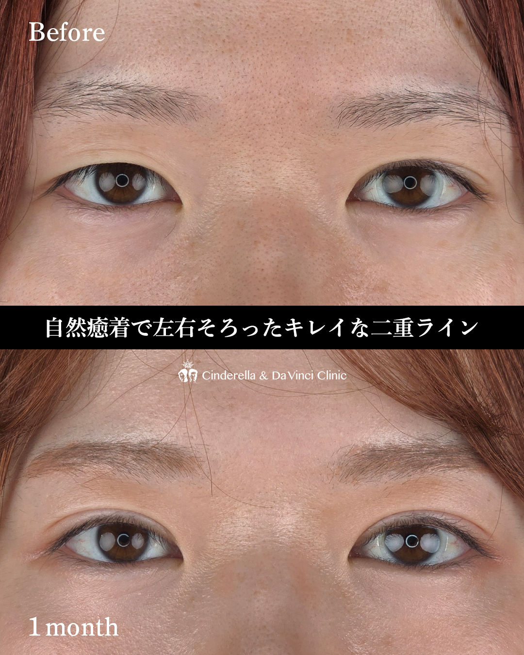 ミックス型二重の画像