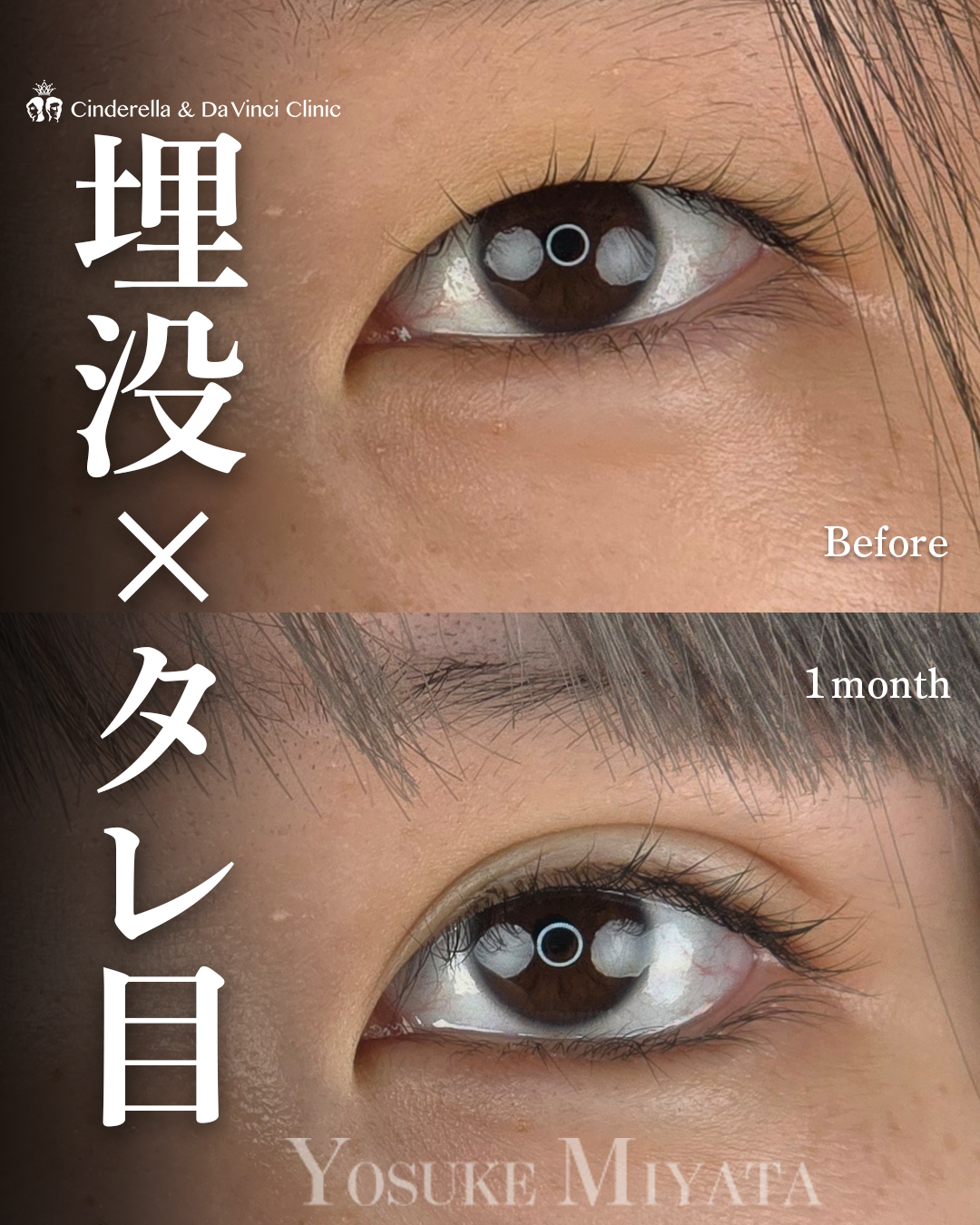 ツリ目をタレ目にの画像