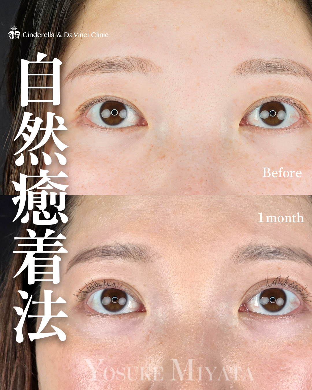 埋没で二重幅を少し広げるの画像