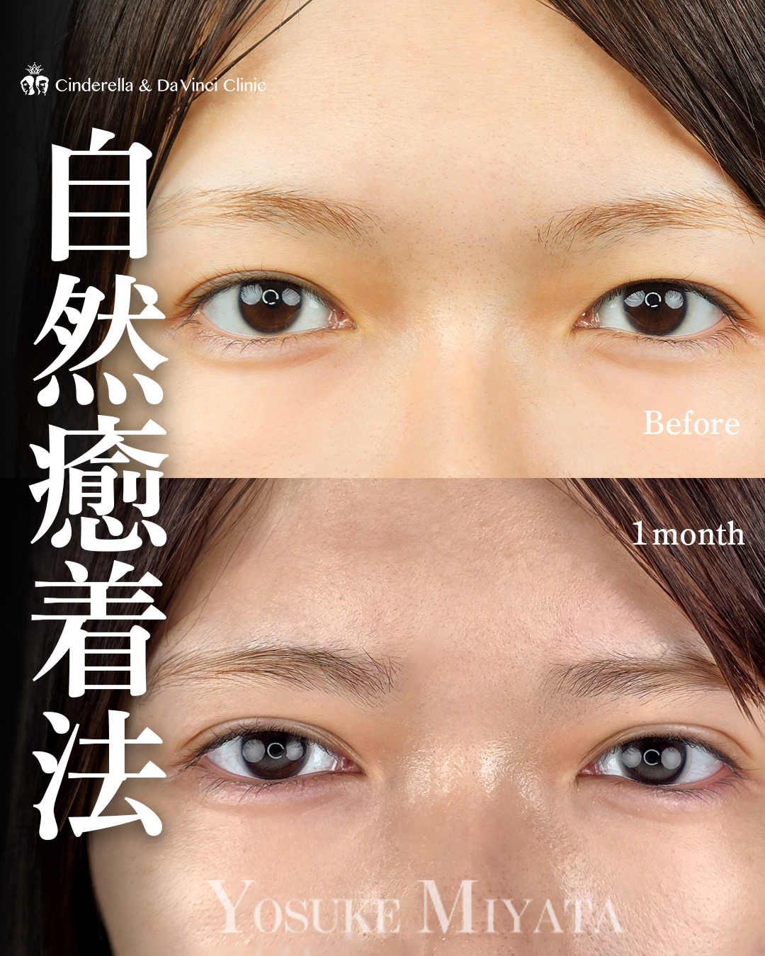 埋没でくっきり二重ラインの画像