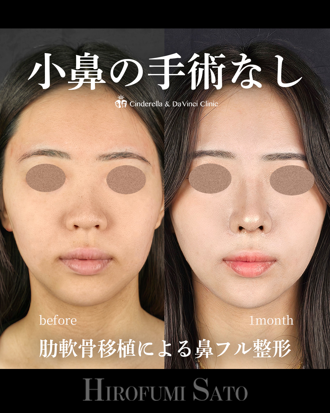 小鼻の手術なしの画像