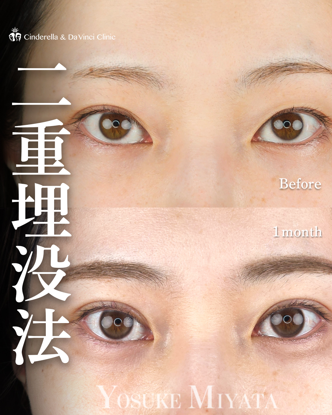 埋没は自然癒着法での画像