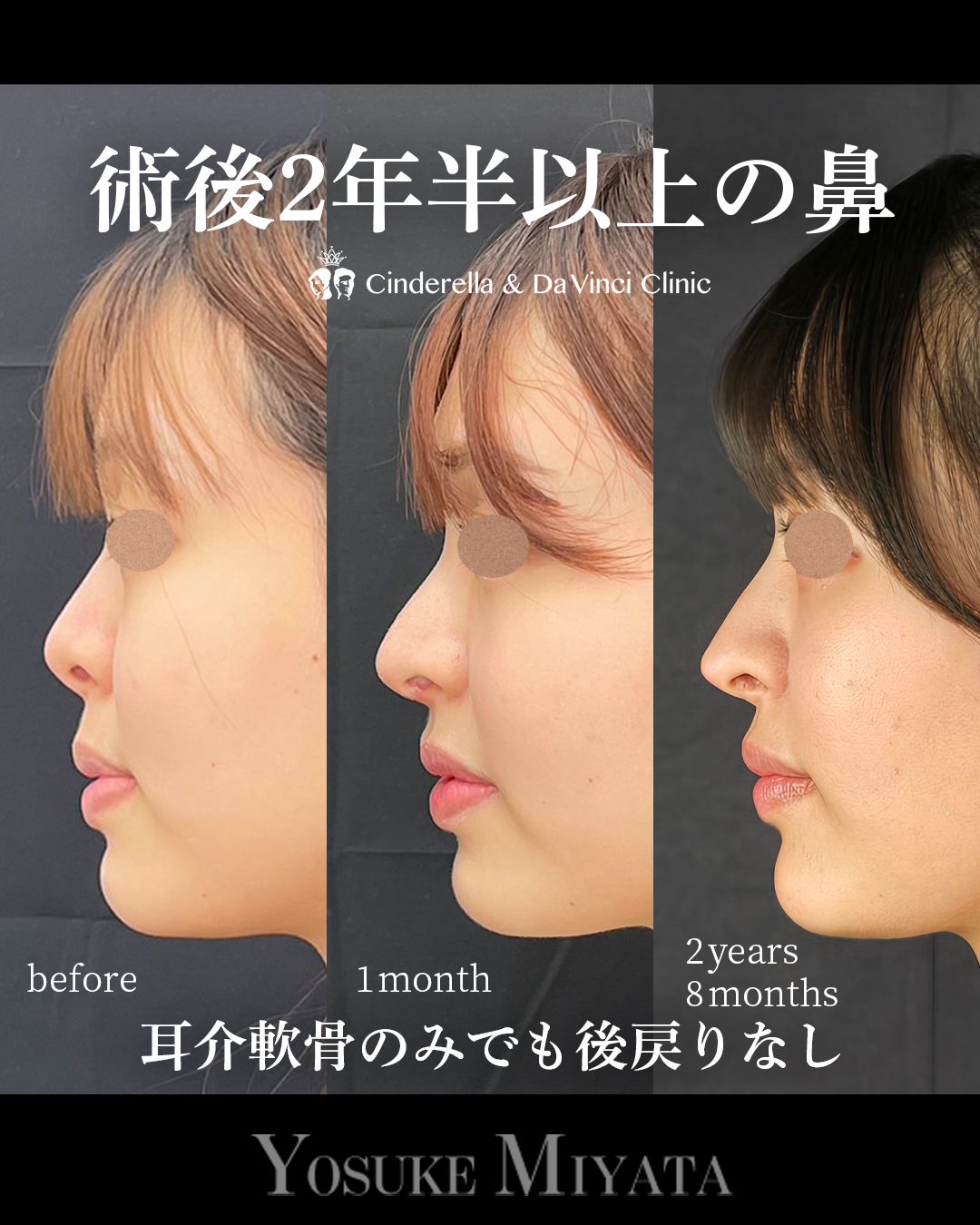 鼻整形から2年以上経過の画像