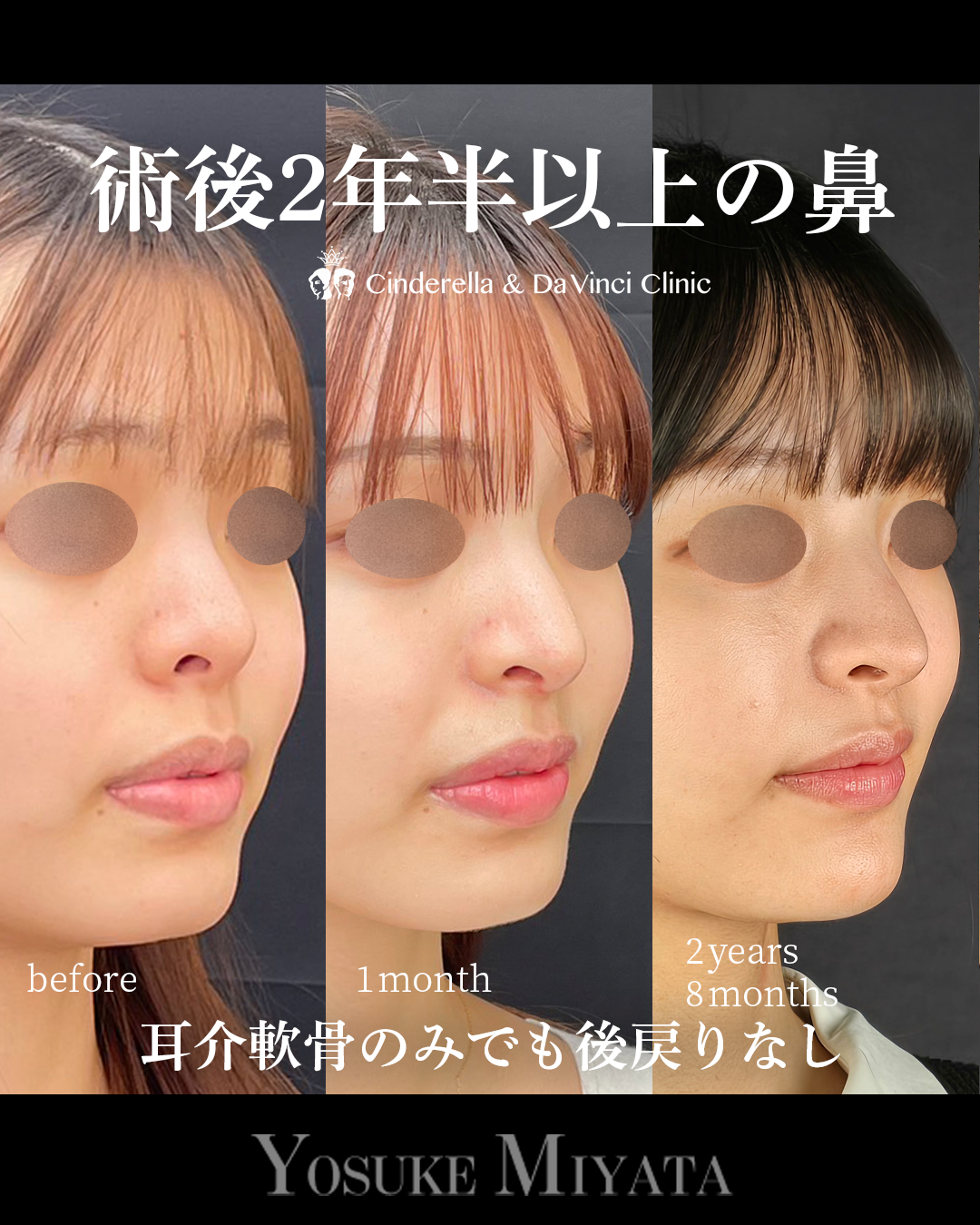 鼻整形から2年以上経過の画像