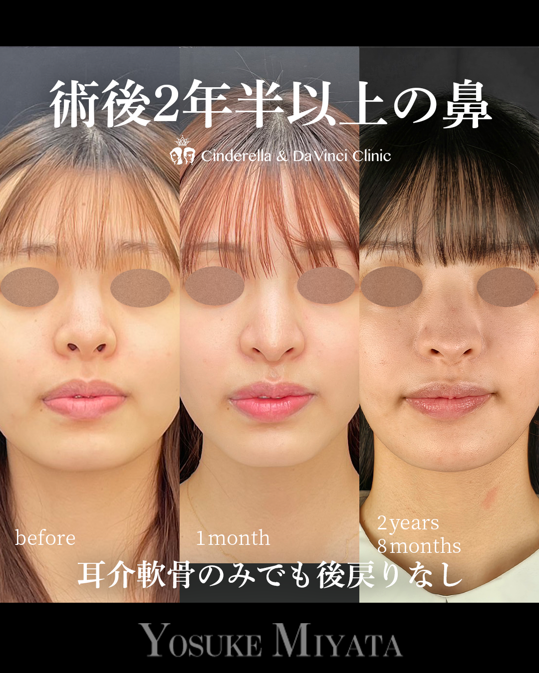 鼻整形から2年以上経過の画像
