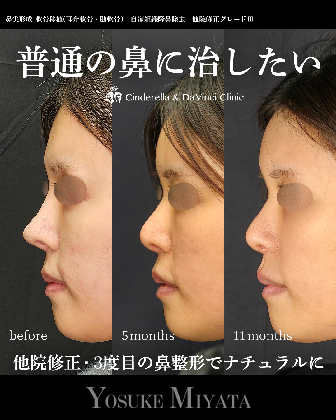 他院修正で普通の鼻に戻すの画像