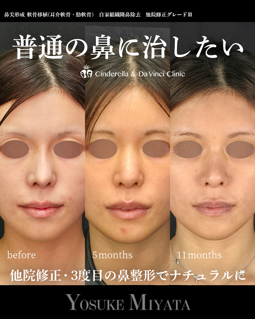 他院修正で普通の鼻に戻すの画像
