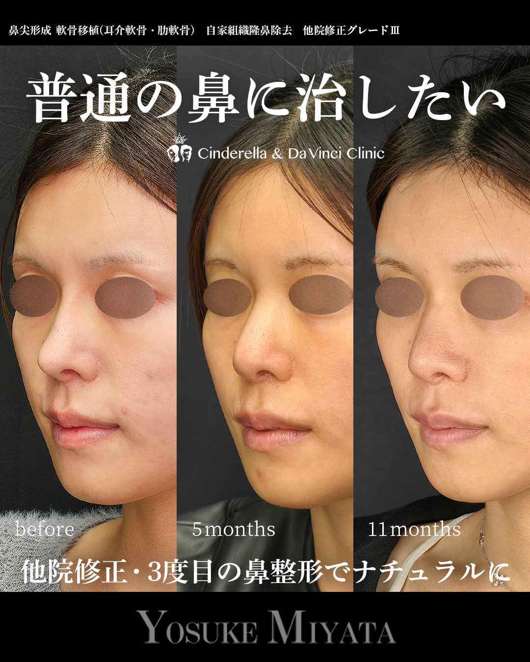 他院修正で普通の鼻に戻すの画像