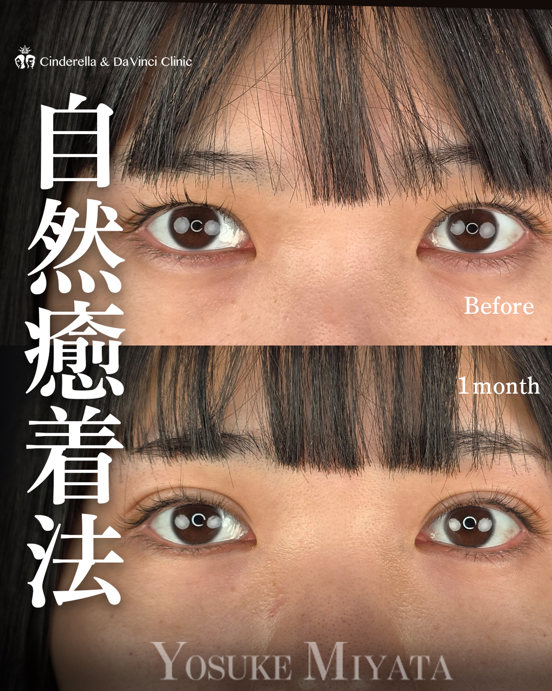 自然癒着法で平行二重の画像