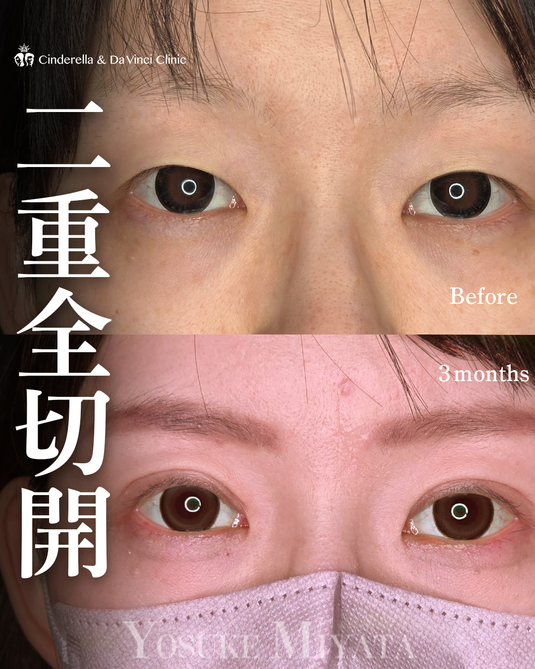 切開で一重からぱっちり二重にの画像