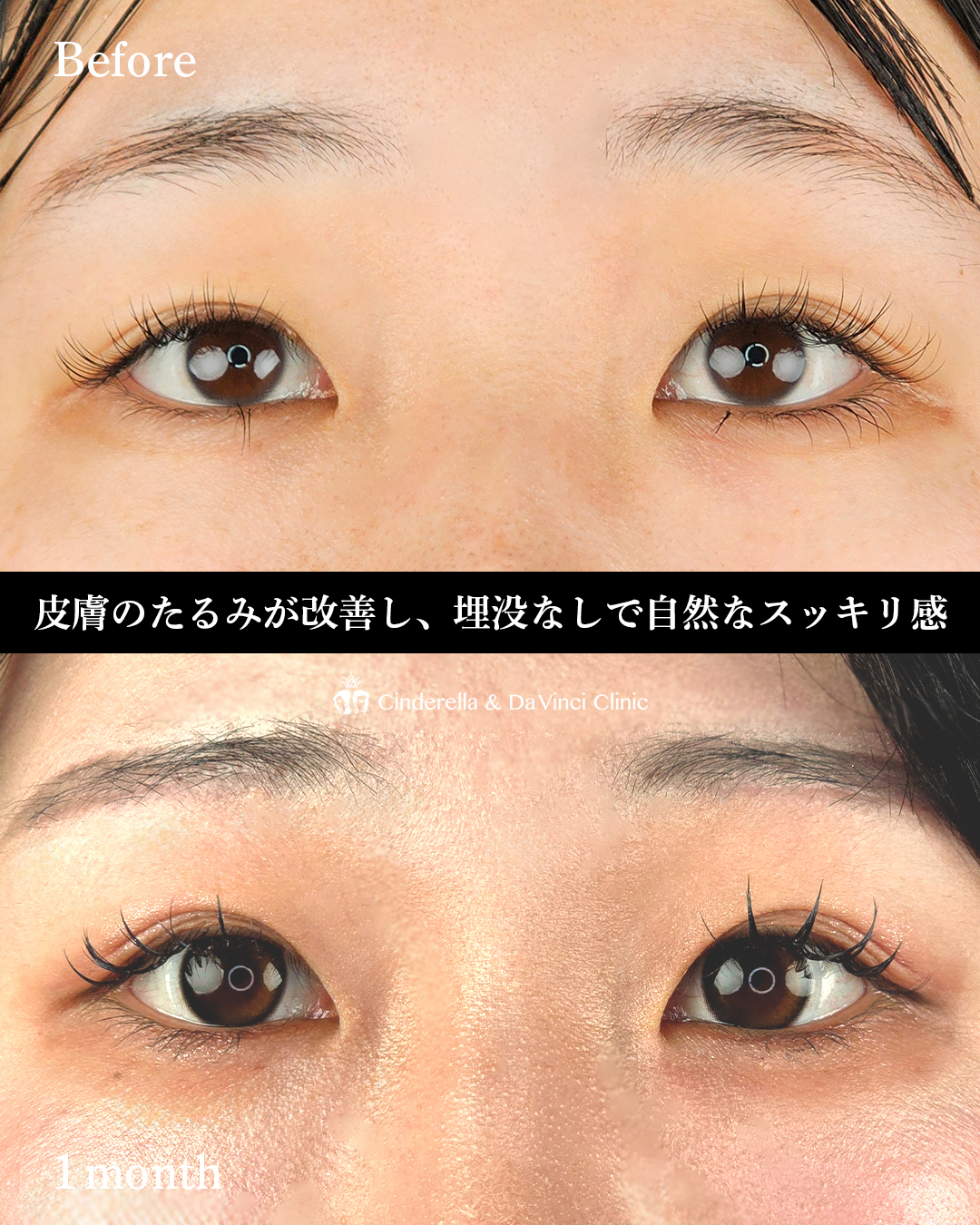 目と眉の距離近づけるの画像