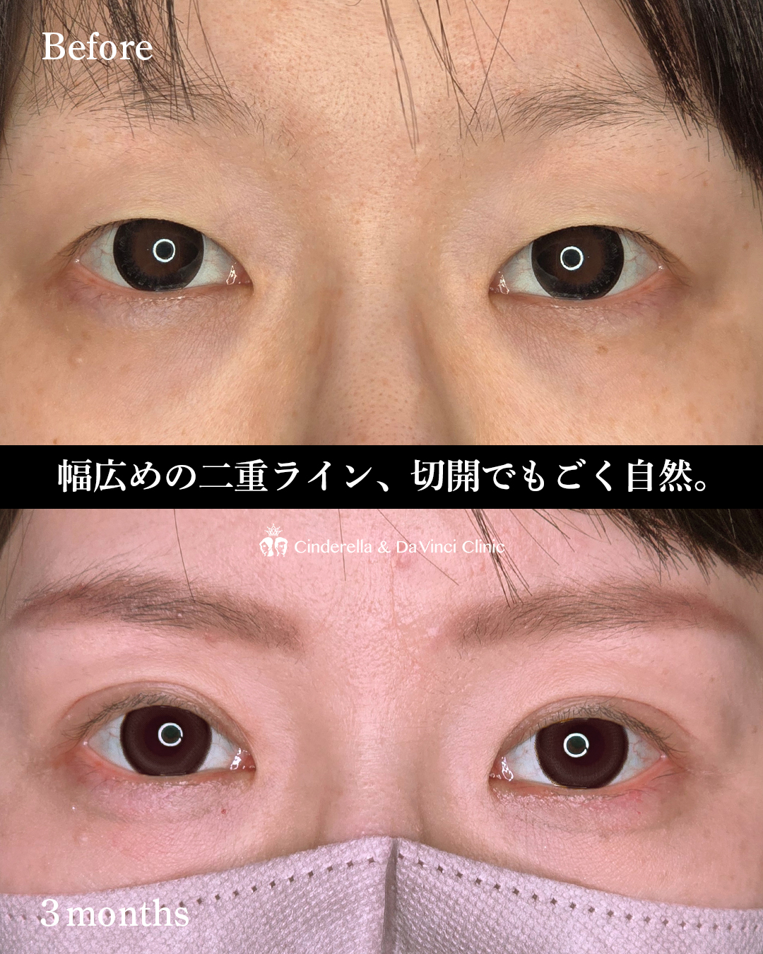 切開で一重からぱっちり二重にの画像