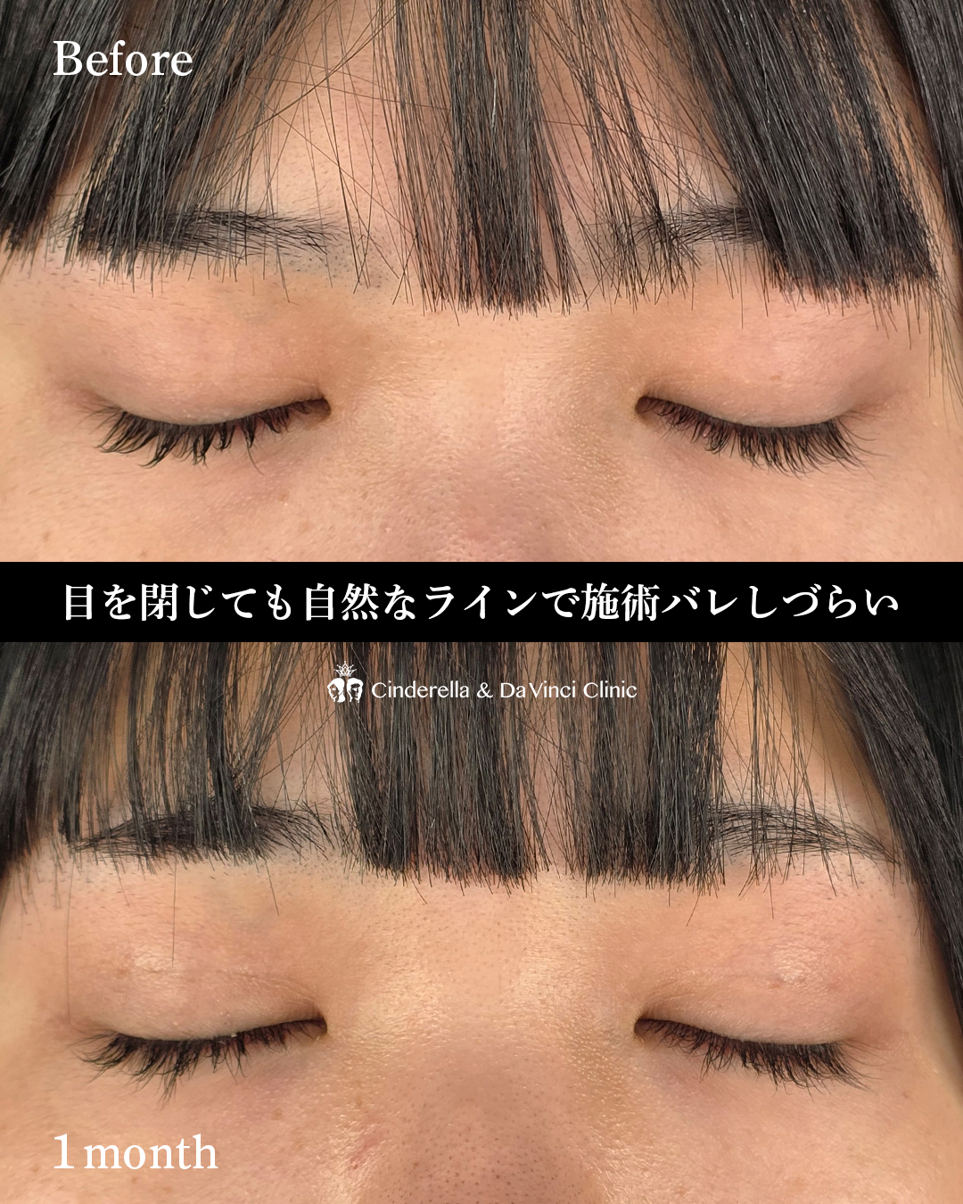 自然癒着法で平行二重の画像