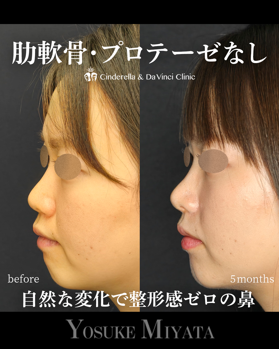 小鼻を小さく自然な変化の画像