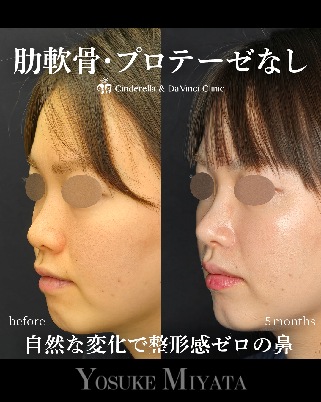 小鼻を小さく自然な変化の画像