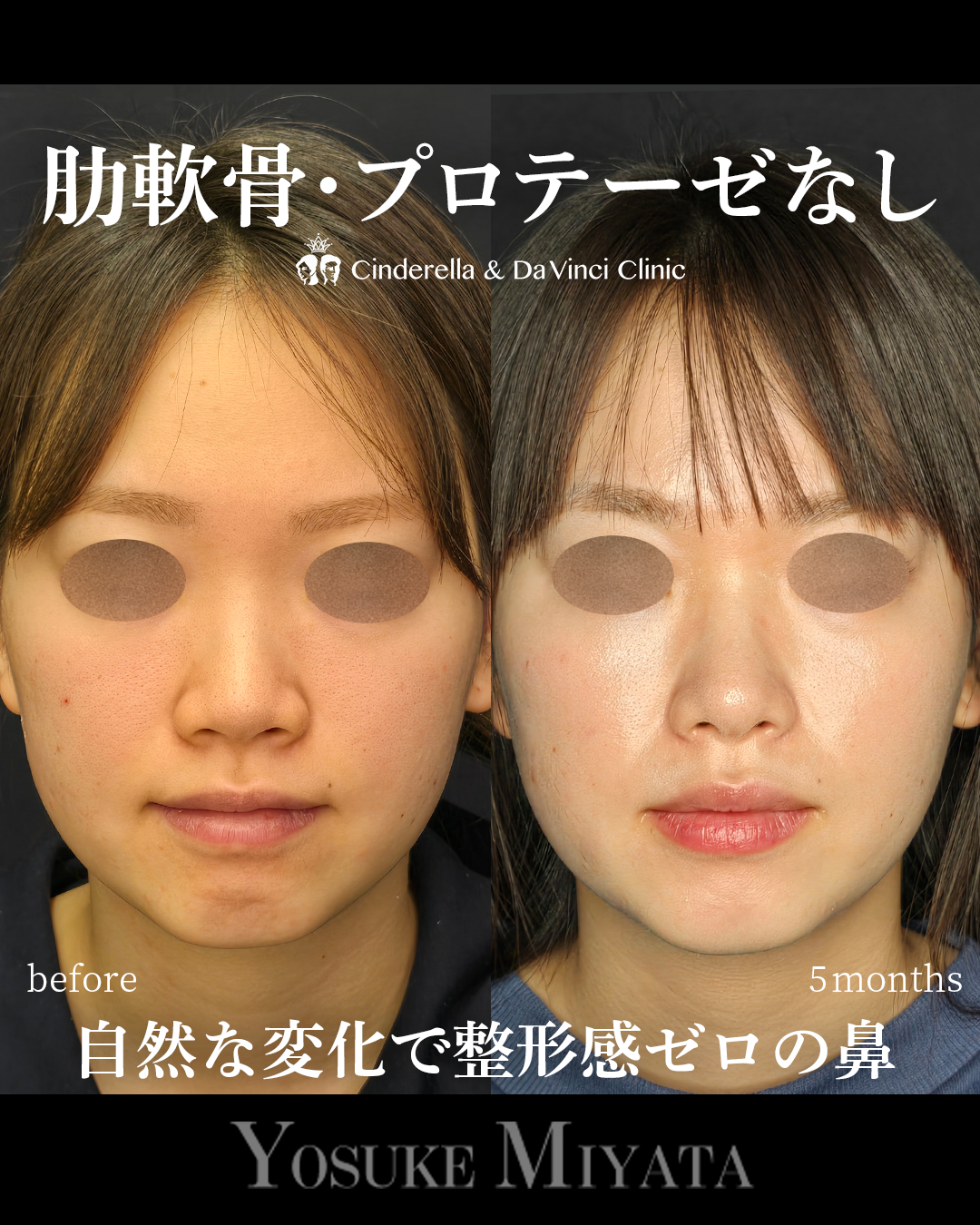 小鼻を小さく自然な変化の画像