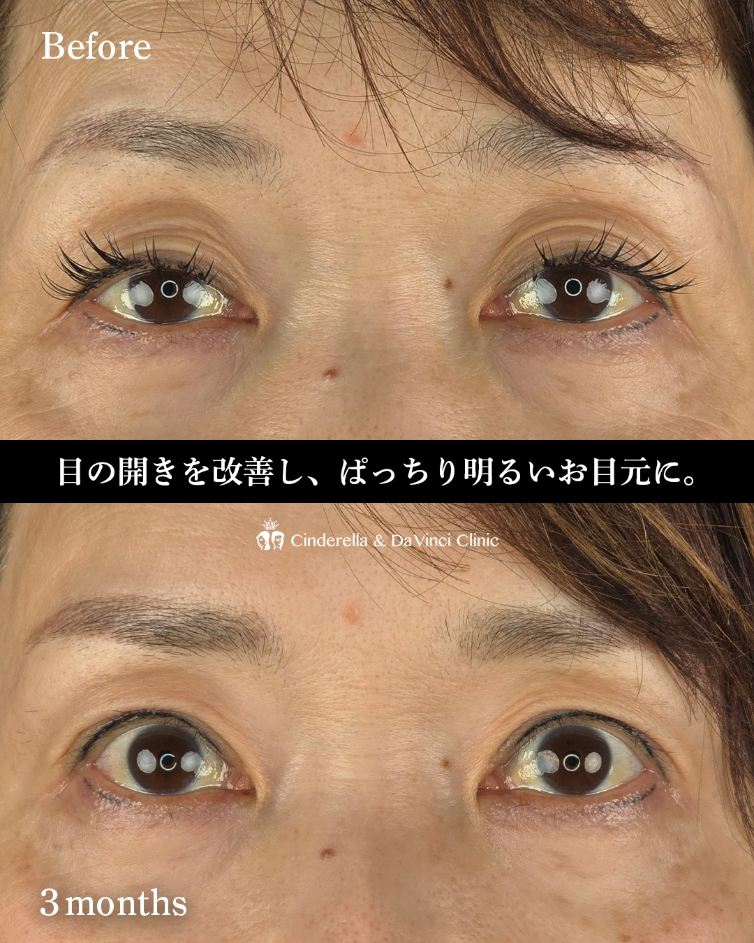 目の開きを改善の画像