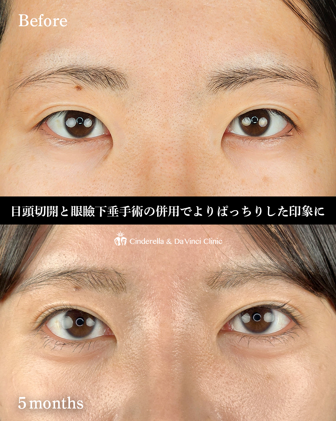 目をぱっちりさせるの画像