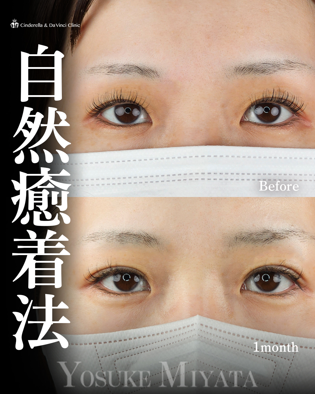 自然な二重の画像