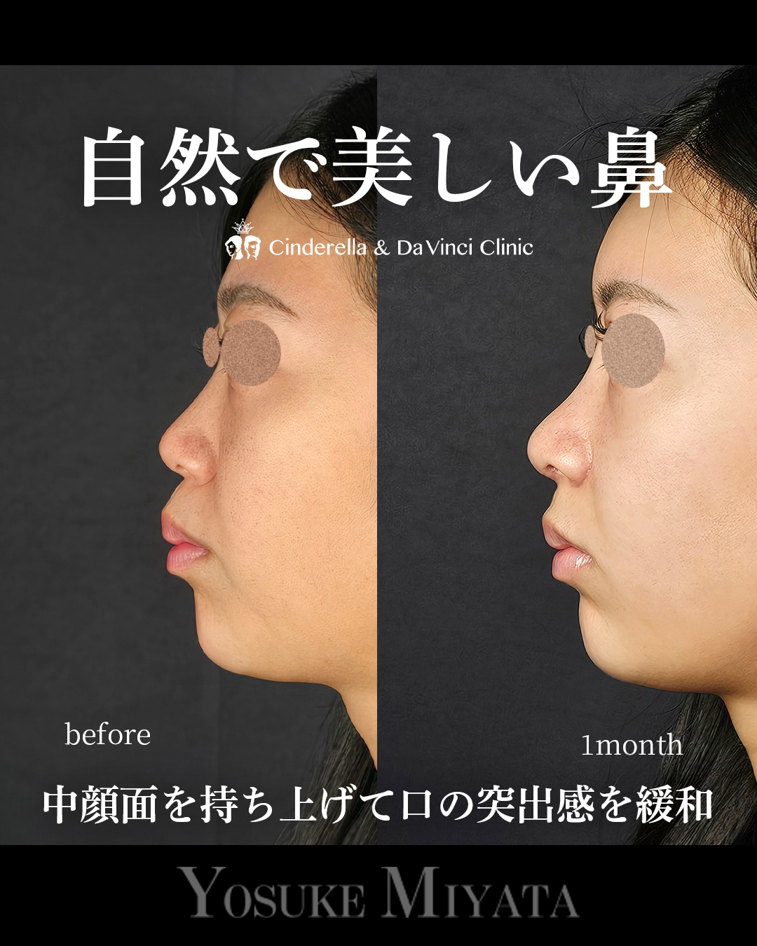 自然で美しい鼻の画像