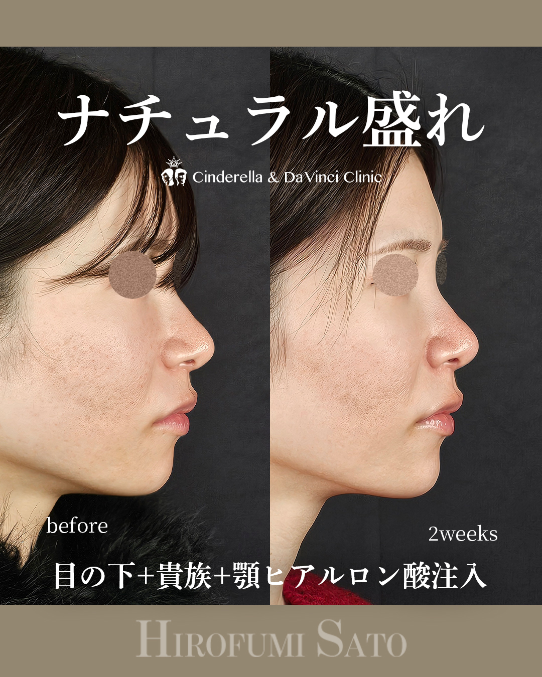 ナチュラル盛れの画像