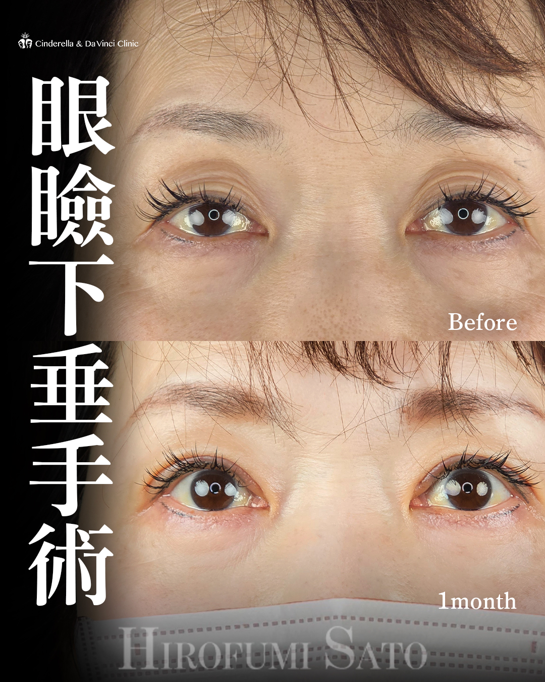 目の開きを改善の画像