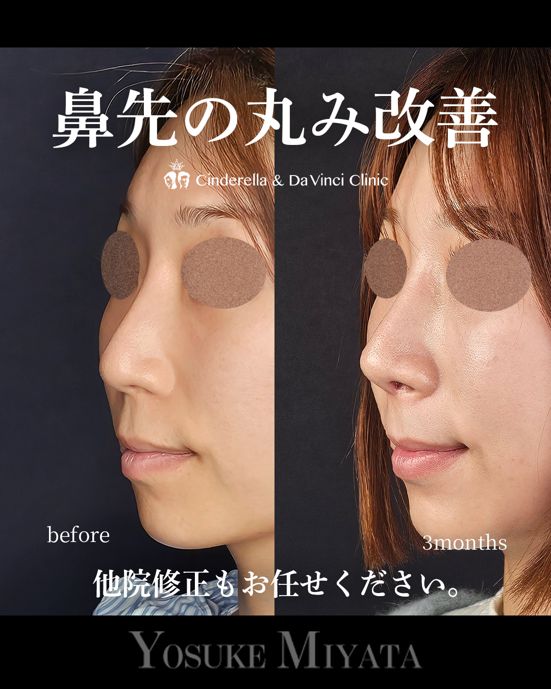 鼻先の丸み改善の画像