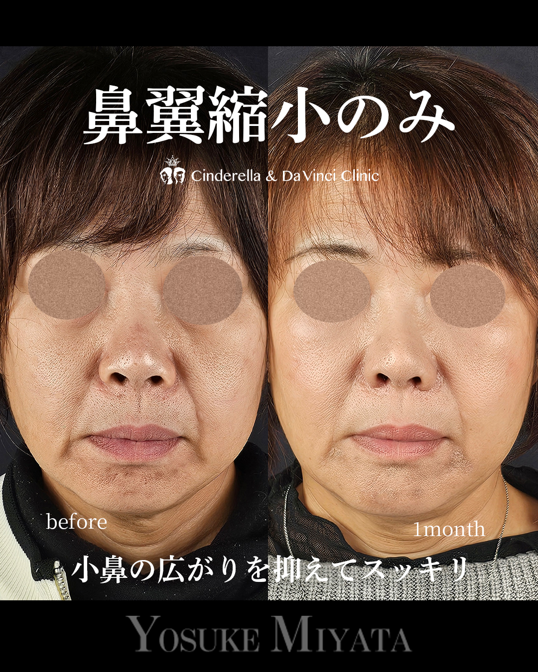 鼻翼縮小のみの画像