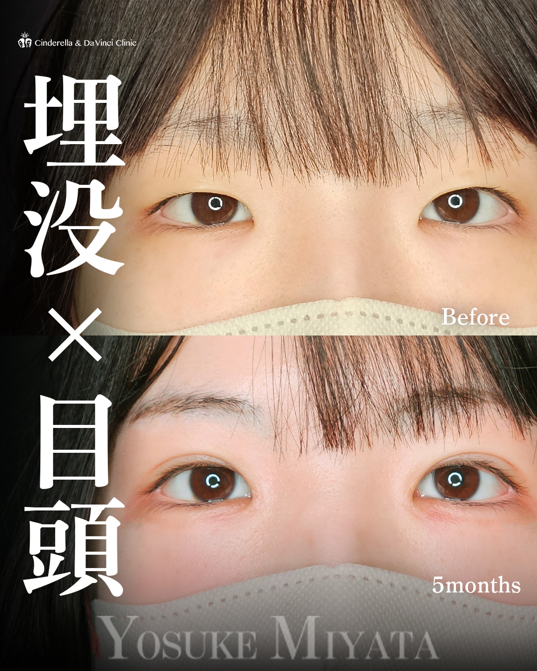 目を大きくするの画像