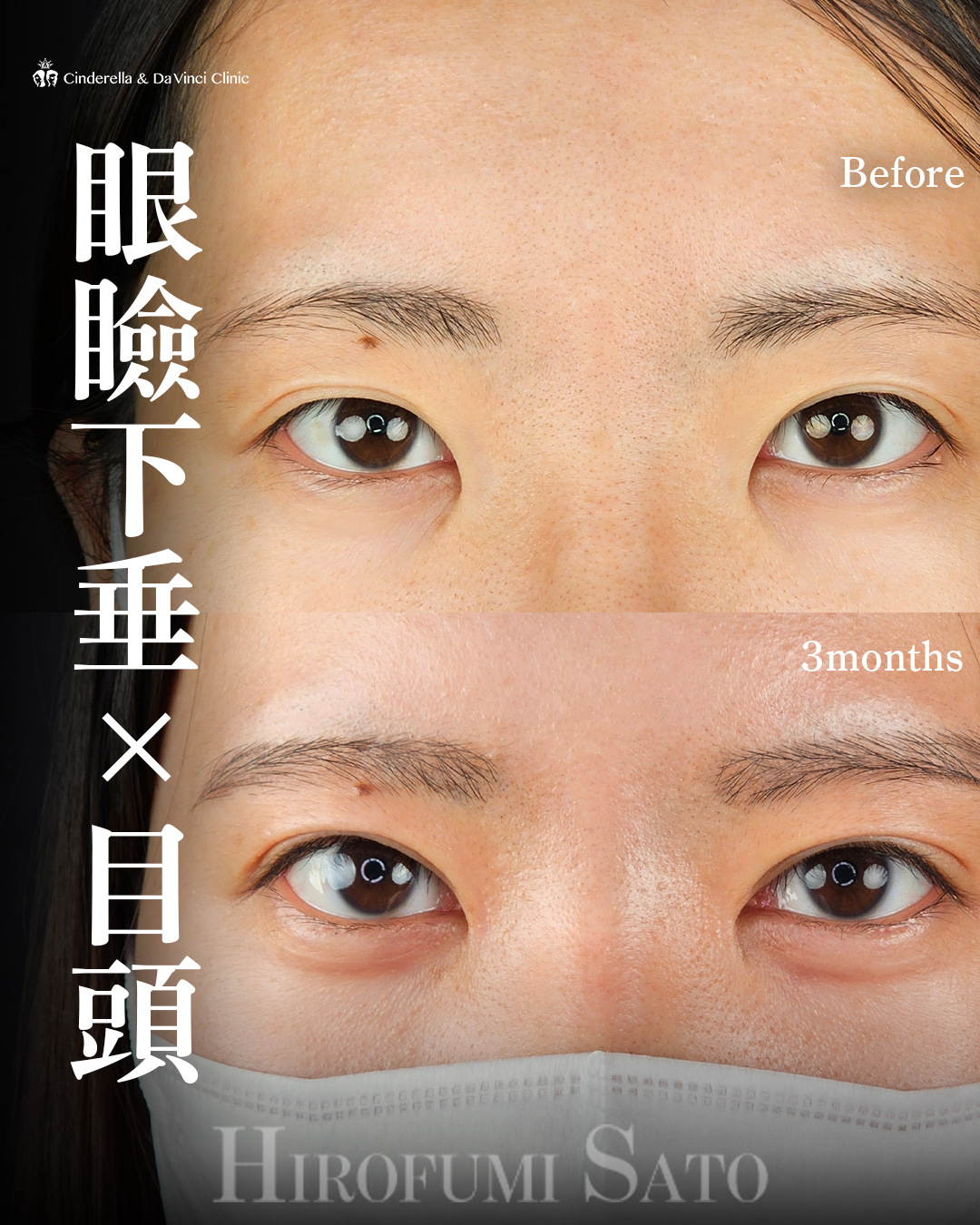 目をぱっちりさせるの画像