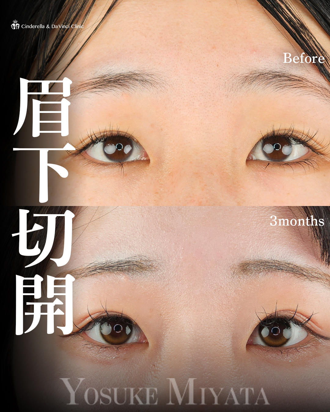 目と眉の距離近づけるの画像