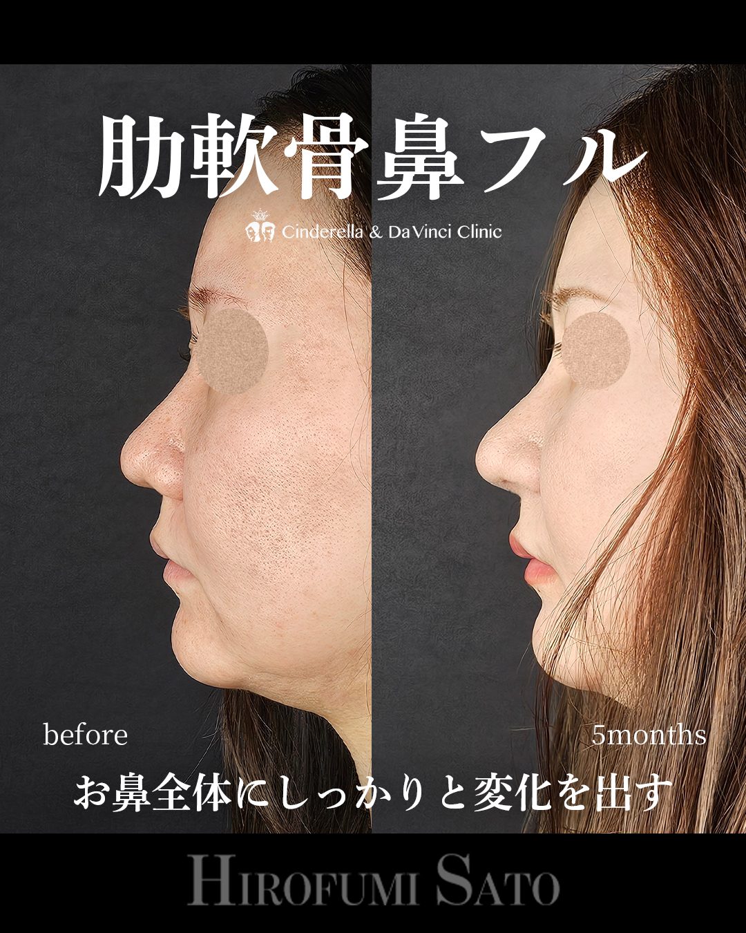 肋軟骨鼻フルの画像