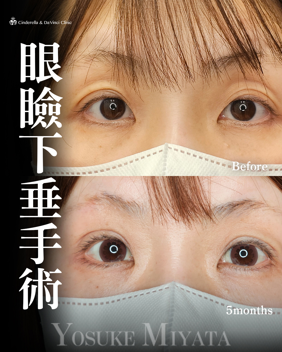 くぼみ目改善の画像