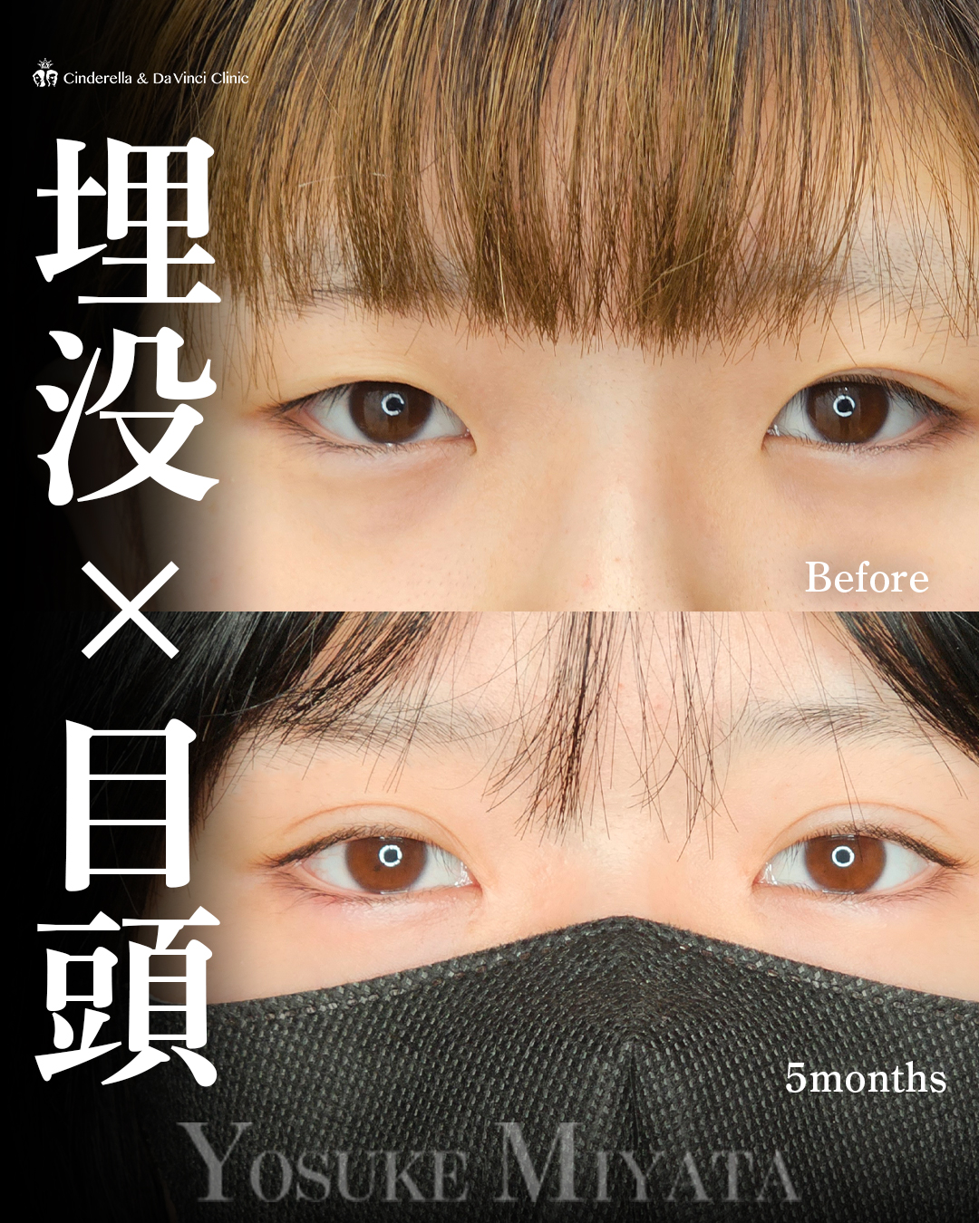 理想の二重にの画像