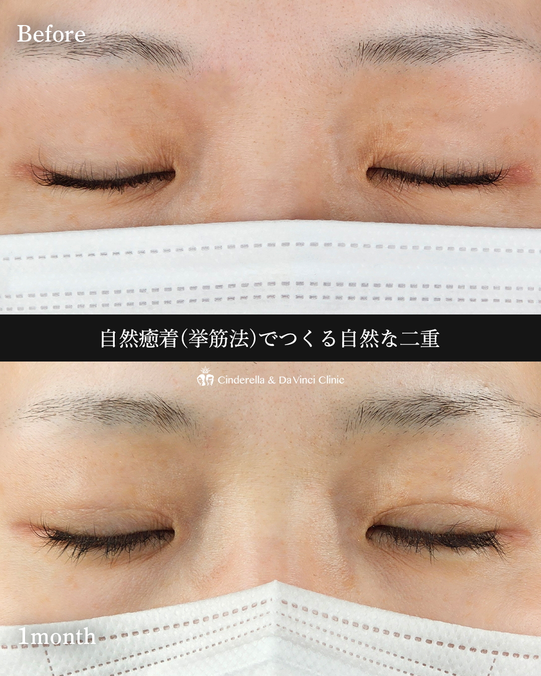 自然な二重の画像