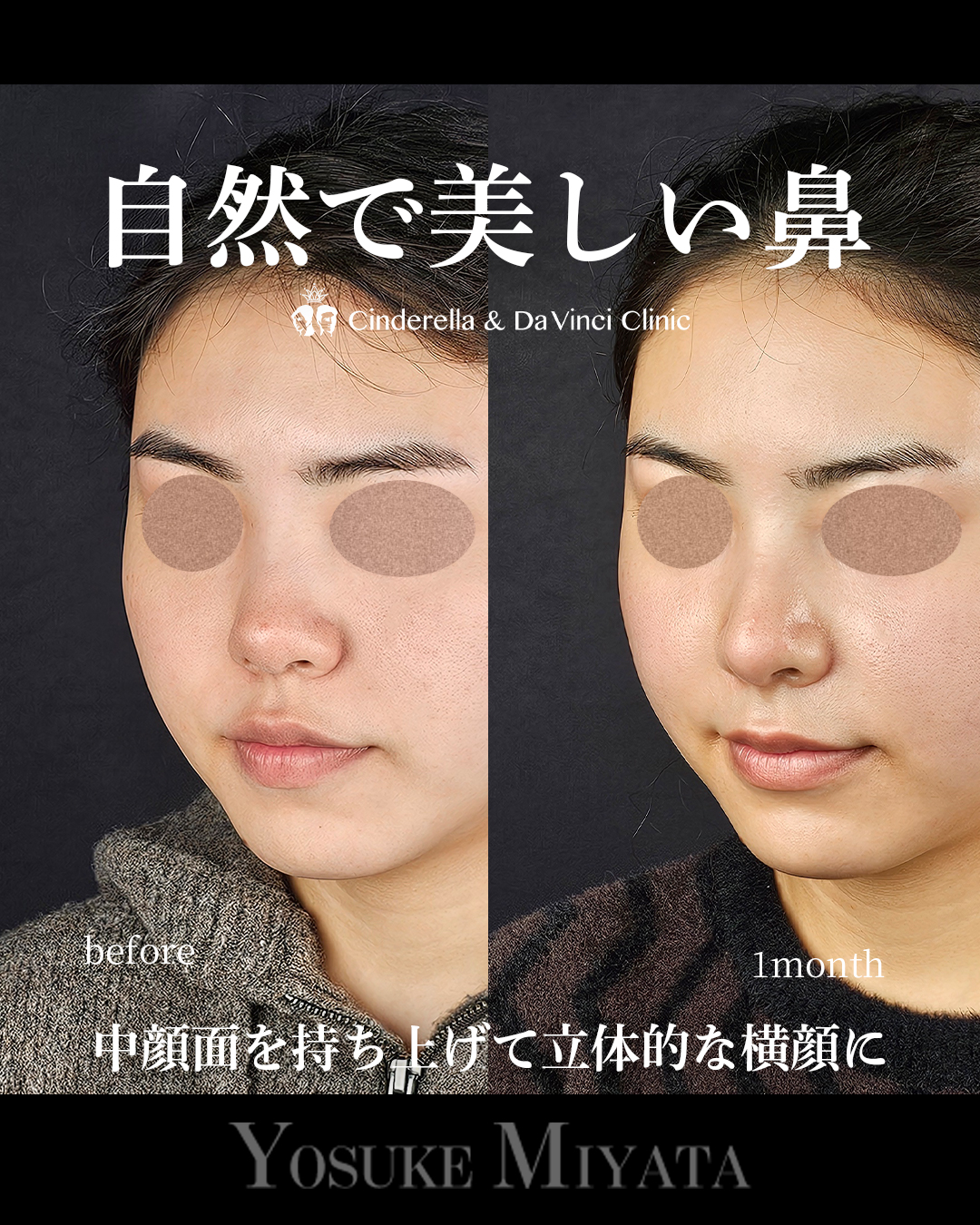 自然で美しい鼻の画像