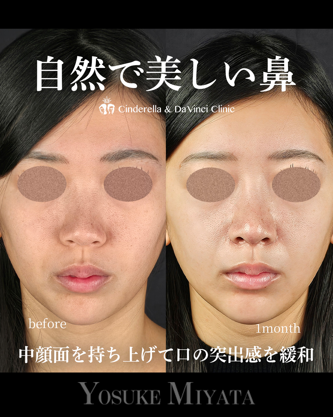 自然で美しい鼻の画像