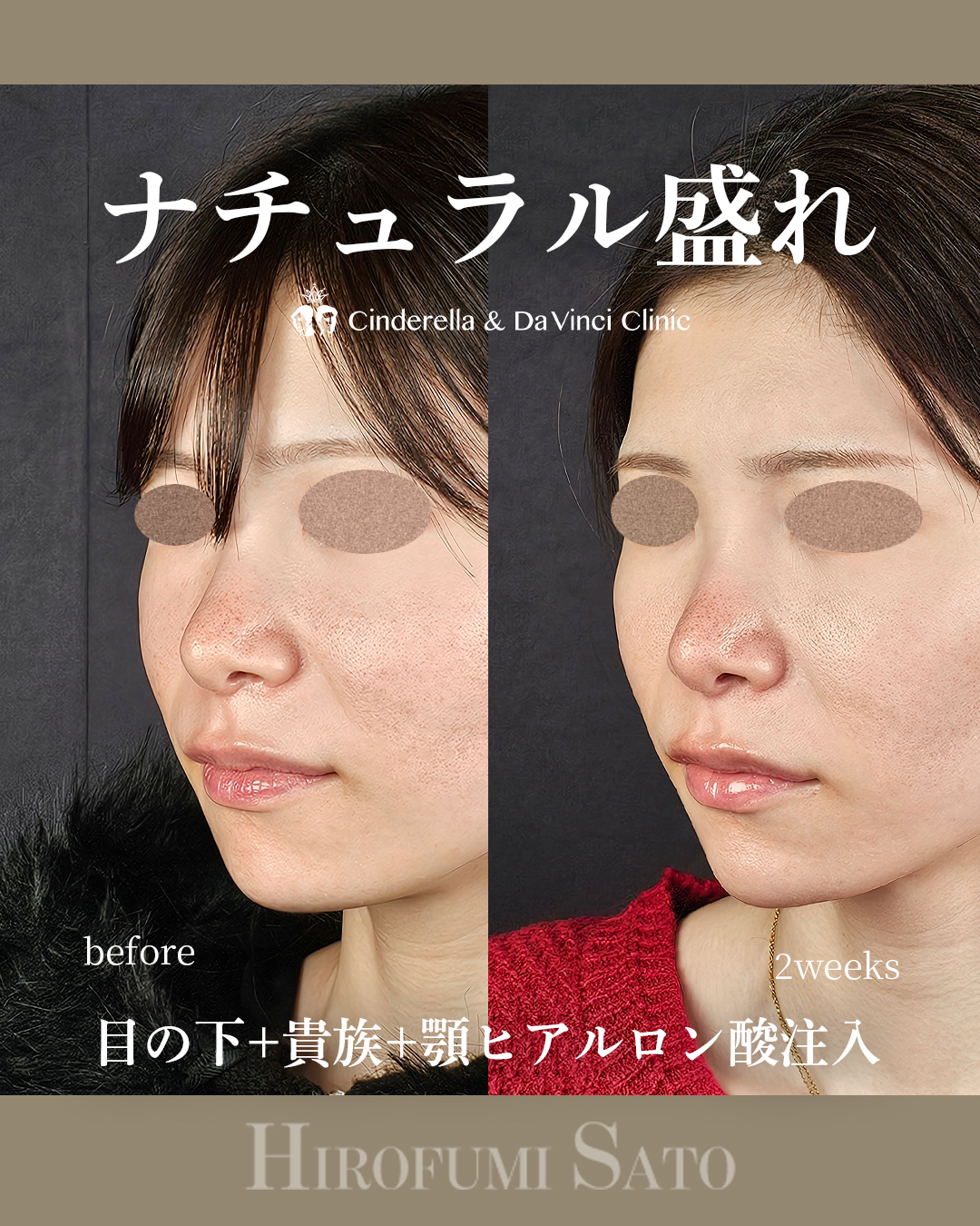 ナチュラル盛れの画像