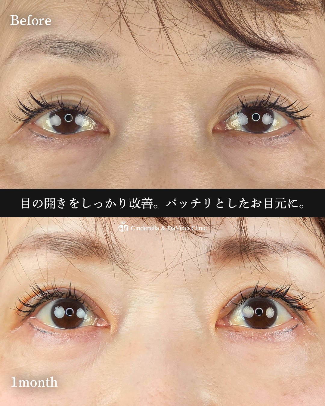 目の開きを改善の画像