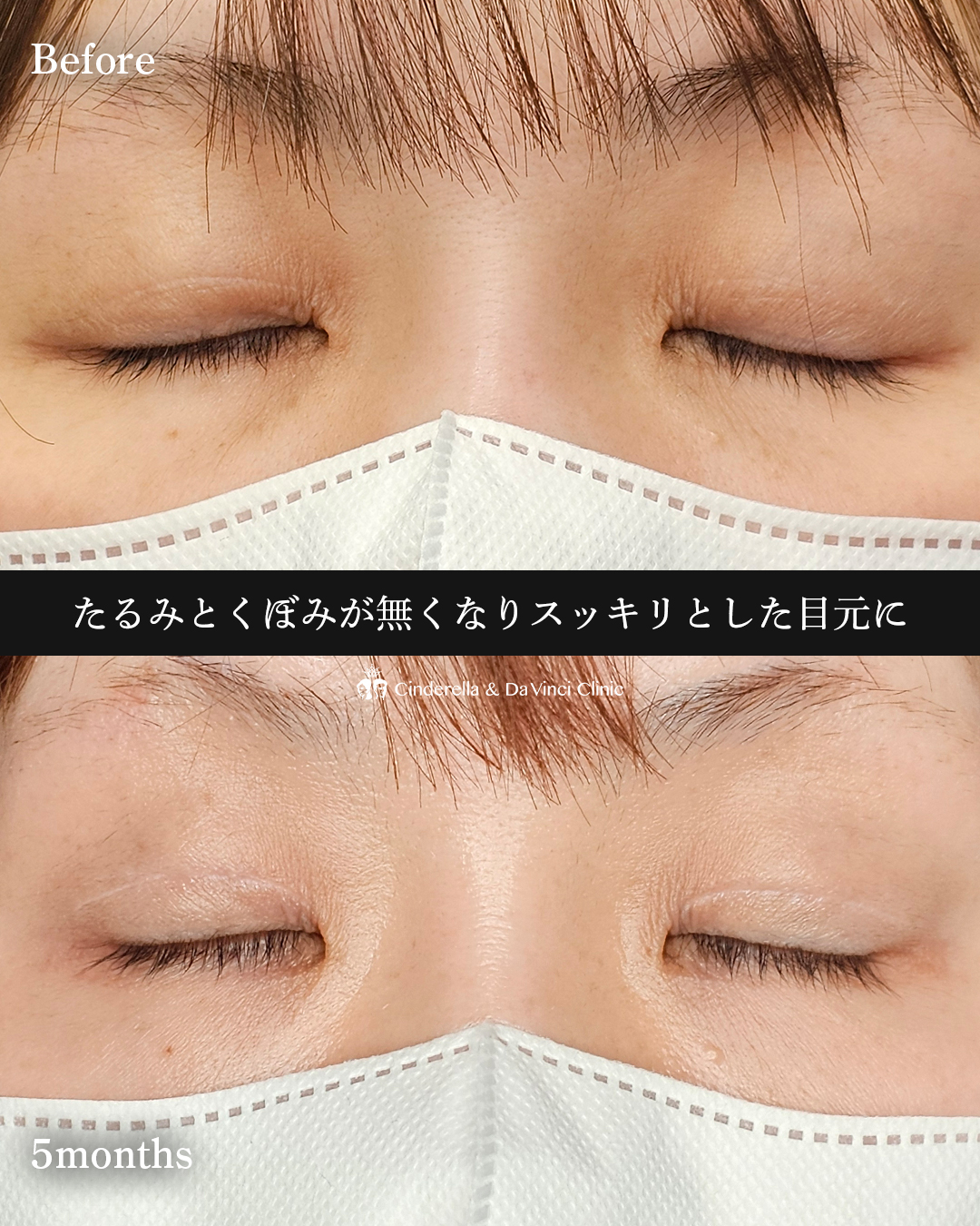 くぼみ目改善の画像