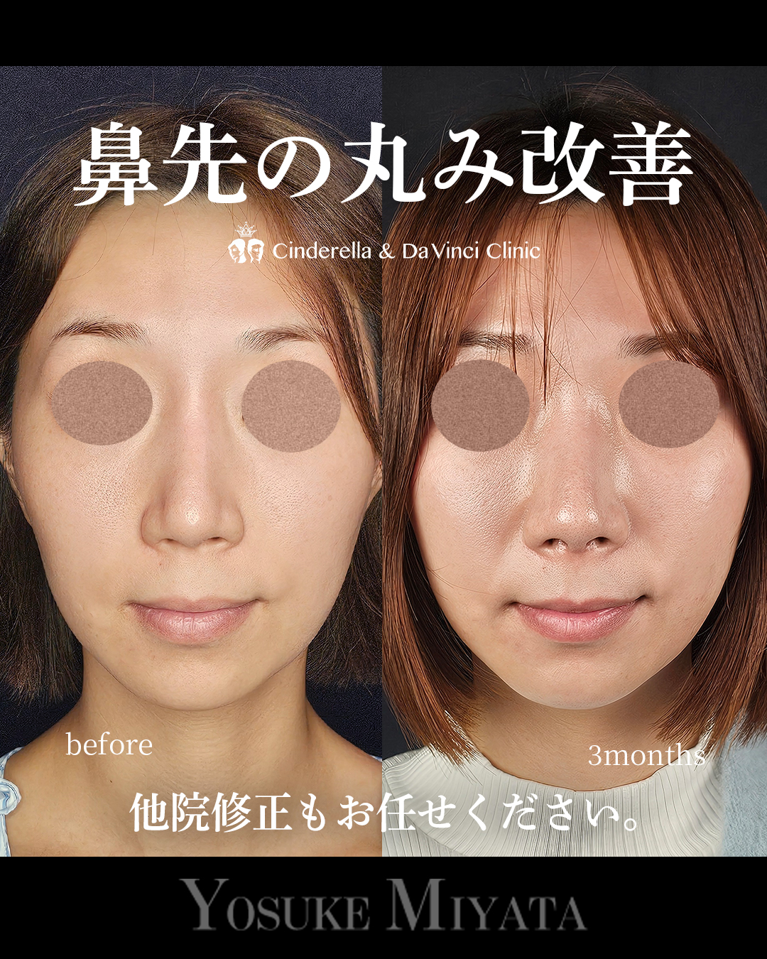 鼻先の丸み改善の画像