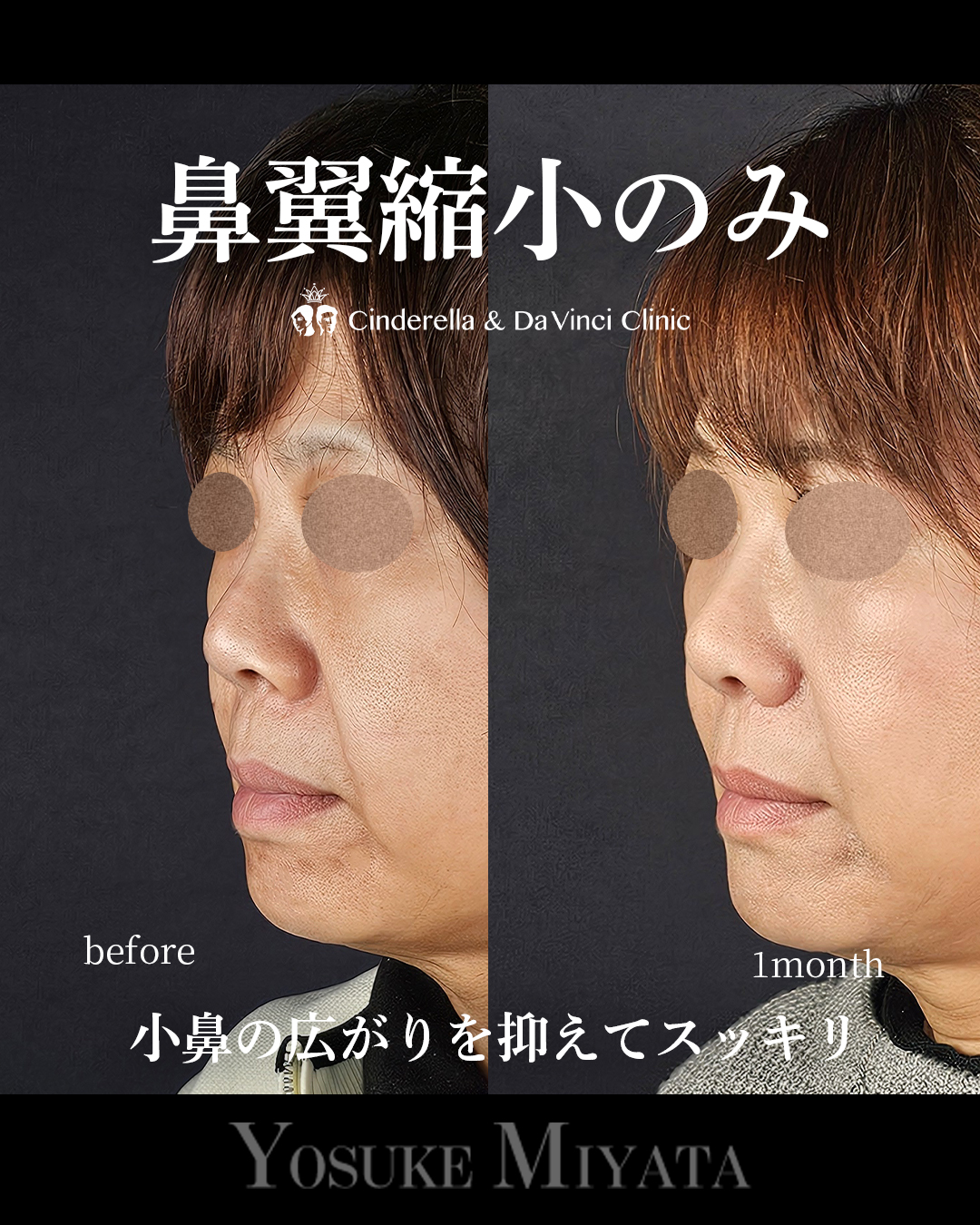 鼻翼縮小のみの画像